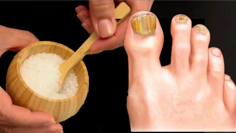 Cette astuce naturelle vous débarrassera des mycoses d&rsquo;ongles en un rien de temps…