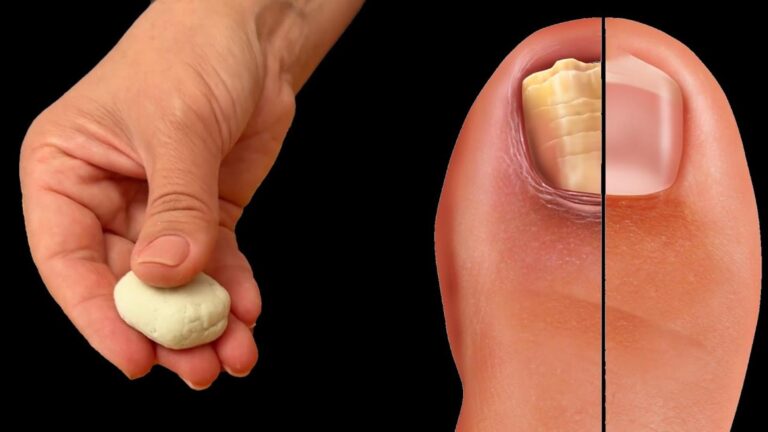Cette méthode simple fait disparaître le mycose des ongles… essayez-la chez vous !