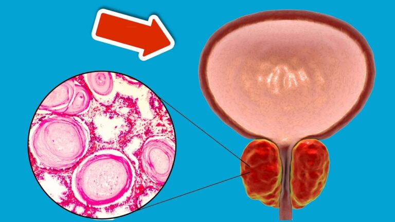6 aliments essentiels pour une prostate en pleine forme à ne pas manquer !