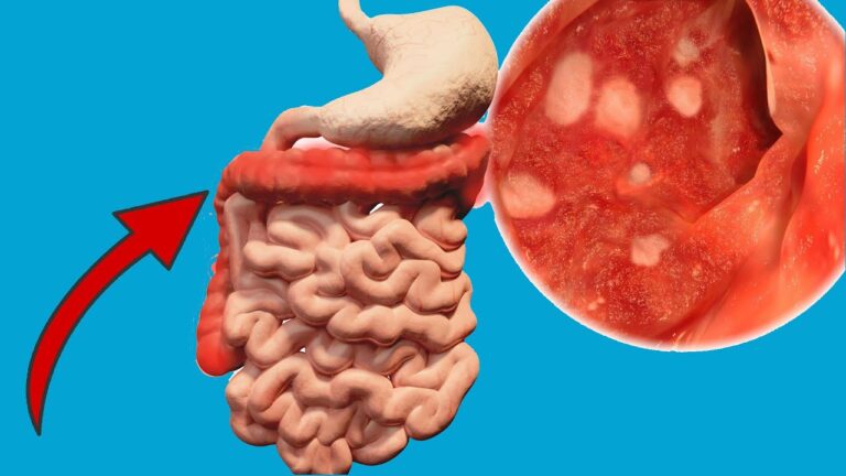 4 aliments à éviter absolument pour soulager un ulcère gastrique et retrouver la santé !