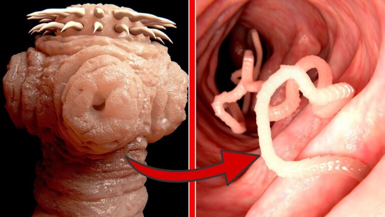 Éliminez 5 parasites intestinaux cachés facilement et rapidement !