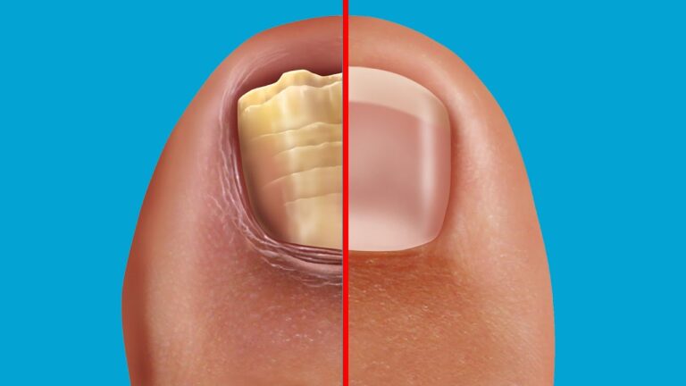 5 remèdes maison efficaces pour combattre le nail fungus rapidement et naturellement !