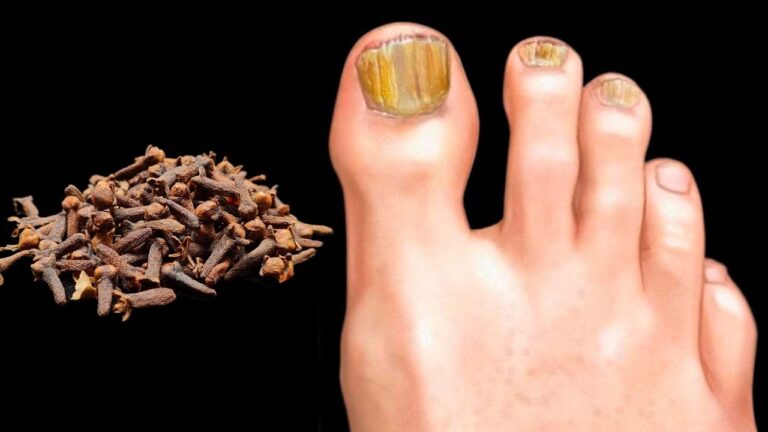 Éliminez le champignon des ongles en 3 étapes simples et efficaces !