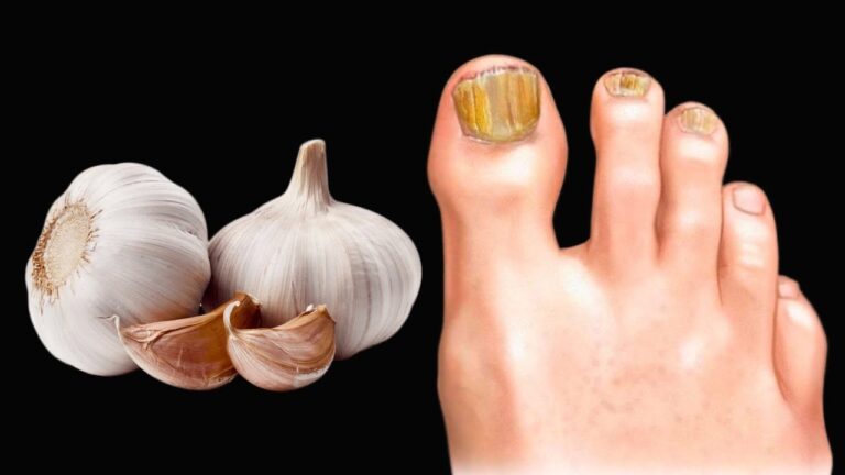 Éliminez le champignon des ongles en 3 étapes simples avec l&rsquo;ail !